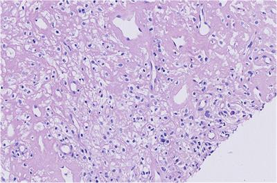 Regional Injection of CAR-T Cells for the Treatment of Refractory and Recurrent Diffuse Large B Cell Lymphoma: A Case Report